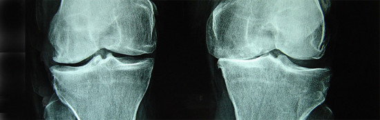 Osteo-Knees
